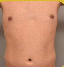 SmartLipo Triplex شفط و شد و نحت الدهون و الجلد بالليزر الامريكي قبل