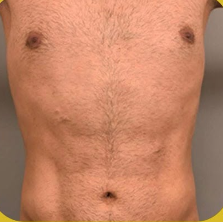 SmartLipo Triplex شفط و شد و نحت الدهون و الجلد بالليزر الامريكي بعد