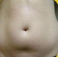SmartLipo Triplex شفط و شد و نحت الدهون و الجلد بالليزر الامريكي قبل