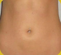 SmartLipo Triplex شفط و شد و نحت الدهون و الجلد بالليزر الامريكي بعد