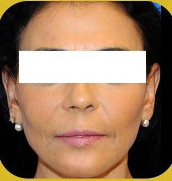 شد الوجه غير الجراحي باستخدام تقنية الاقماع الحديثة المطورة بعد