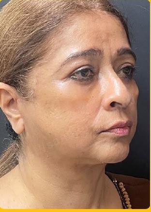 شد الوجه غير الجراحي باستخدام تقنية الاقماع الحديثة المطورة بعد