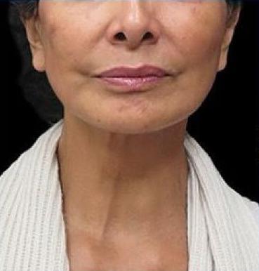 شد الوجه غير الجراحي باستخدام تقنية الاقماع الحديثة المطورة بعد