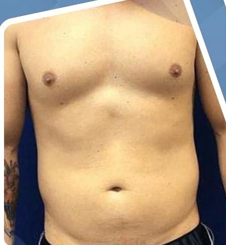 SmartLipo Triplex شفط و شد و نحت الدهون و الجلد بالليزر الامريكي قبل