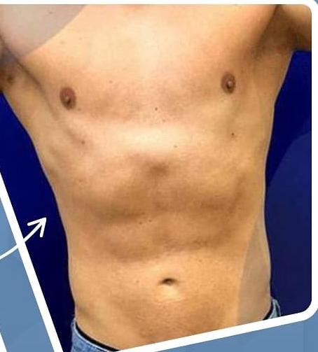 SmartLipo Triplex شفط و شد و نحت الدهون و الجلد بالليزر الامريكي بعد