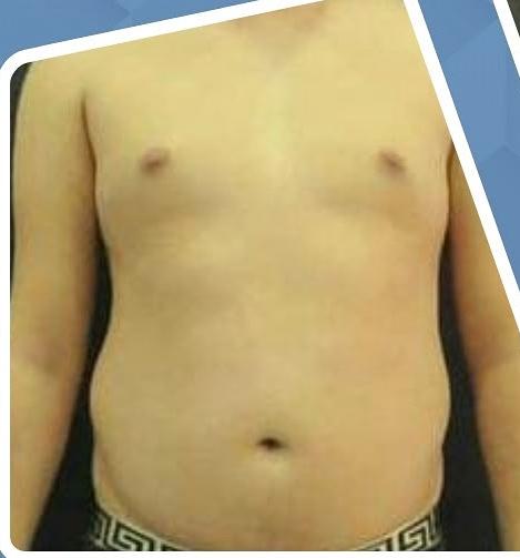 SmartLipo Triplex شفط و شد و نحت الدهون و الجلد بالليزر الامريكي قبل