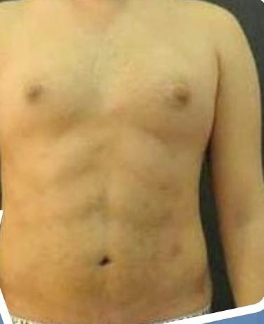 SmartLipo Triplex شفط و شد و نحت الدهون و الجلد بالليزر الامريكي بعد