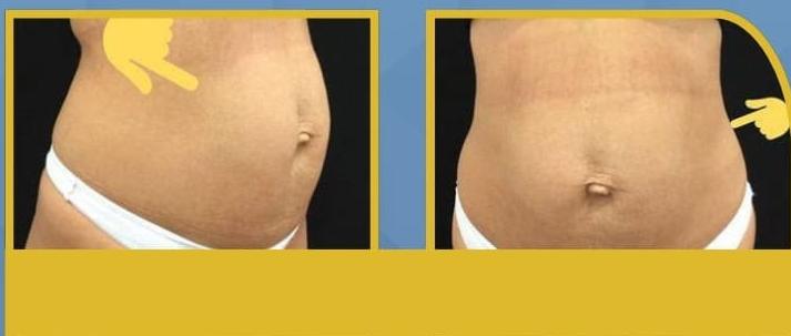 SmartLipo Triplex شفط و شد و نحت الدهون و الجلد بالليزر الامريكي قبل