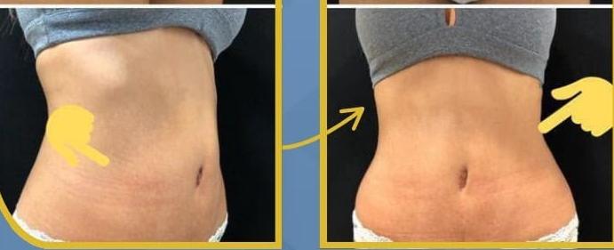 SmartLipo Triplex شفط و شد و نحت الدهون و الجلد بالليزر الامريكي بعد