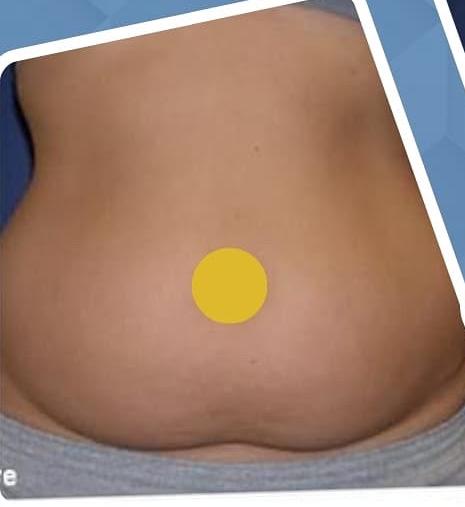 SmartLipo Triplex شفط و شد و نحت الدهون و الجلد بالليزر الامريكي قبل