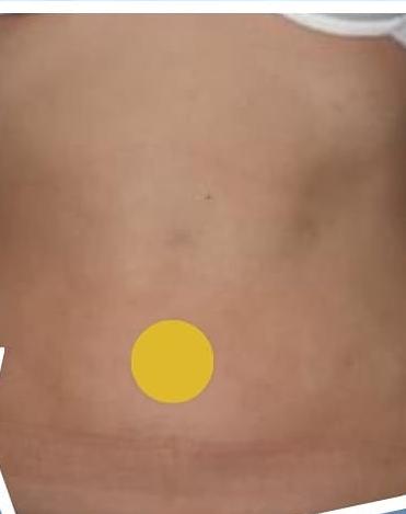 SmartLipo Triplex شفط و شد و نحت الدهون و الجلد بالليزر الامريكي بعد