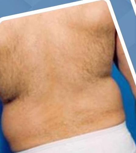 SmartLipo Triplex شفط و شد و نحت الدهون و الجلد بالليزر الامريكي قبل