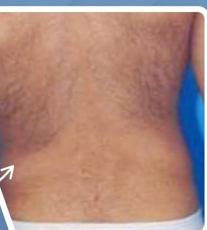 SmartLipo Triplex شفط و شد و نحت الدهون و الجلد بالليزر الامريكي بعد