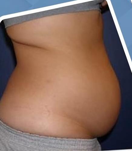 SmartLipo Triplex شفط و شد و نحت الدهون و الجلد بالليزر الامريكي قبل