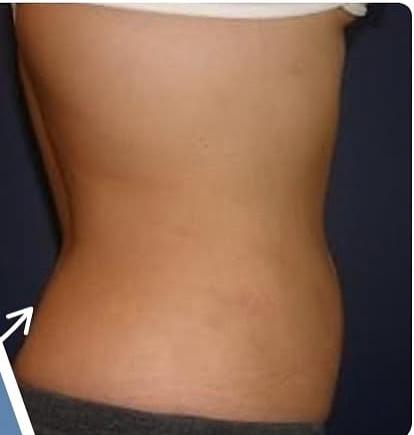 SmartLipo Triplex شفط و شد و نحت الدهون و الجلد بالليزر الامريكي بعد