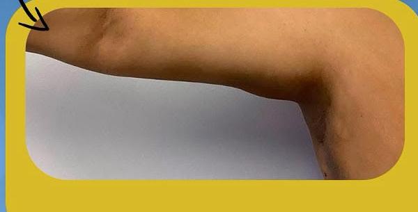 SmartLipo Triplex شفط و شد و نحت الدهون و الجلد بالليزر الامريكي بعد