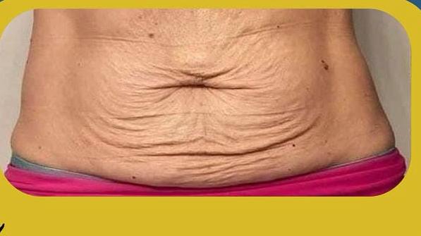 SmartLipo Triplex شفط و شد و نحت الدهون و الجلد بالليزر الامريكي قبل