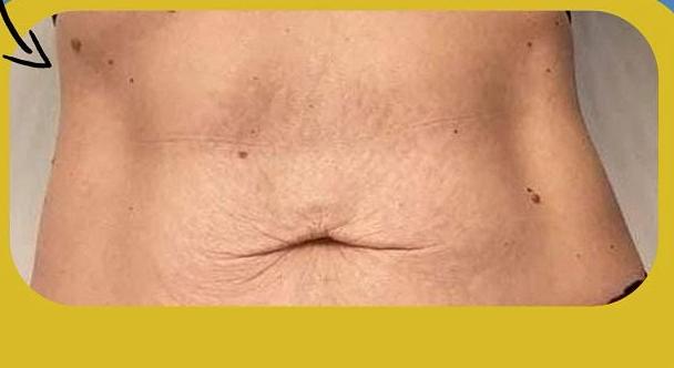SmartLipo Triplex شفط و شد و نحت الدهون و الجلد بالليزر الامريكي بعد