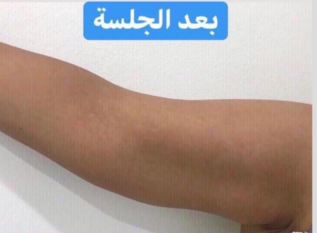 التبريد وتخسيس الدهون الموضعية بدون جراحة 2