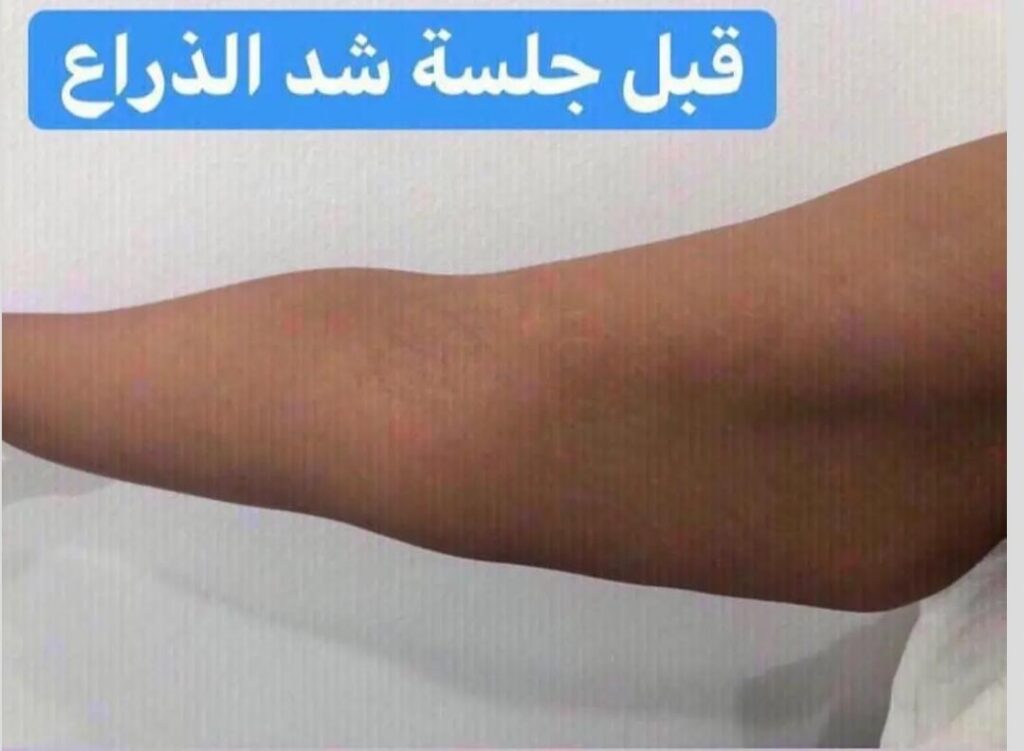 التبريد وتخسيس الدهون الموضعية بدون جراحة 1