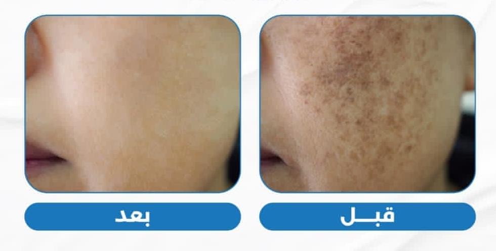 علاج التصبغات والكلف والنمش 1