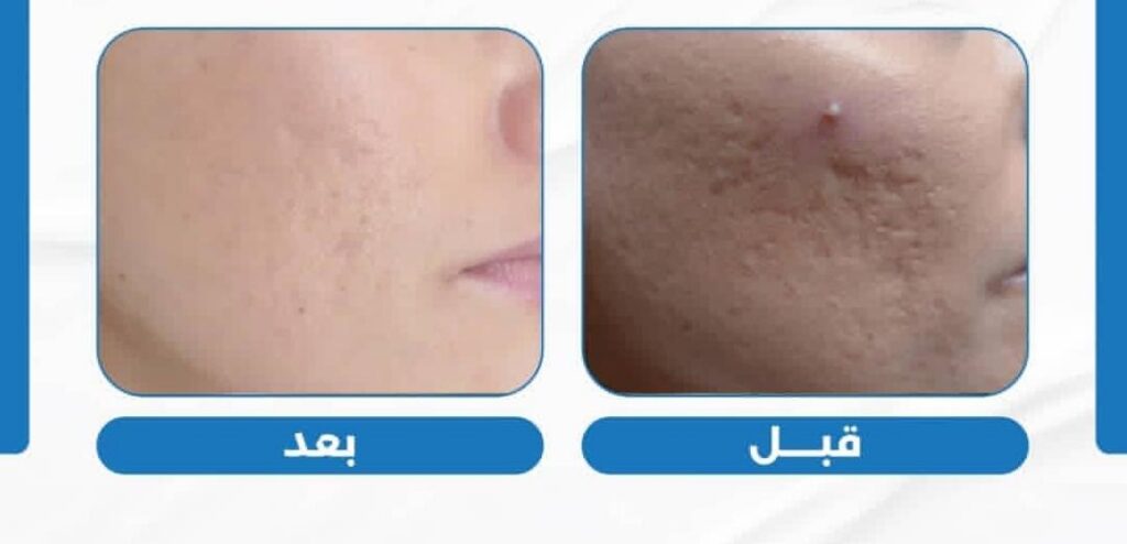 علاج الندبات وآثار الحبوب 1